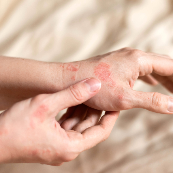 Managing Eczema: Science-backed Solutions for Daily Care